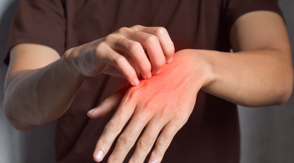 Uyuz vakaları her geçen gün artıyor: Uzmanı vakalara karşı uyardı